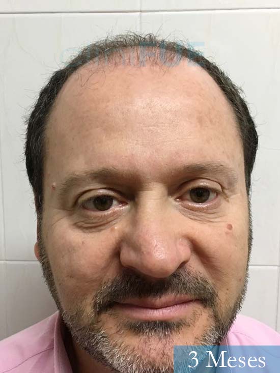 Jordi 56 Tarragona trasplante capilar turquia 3 meses 