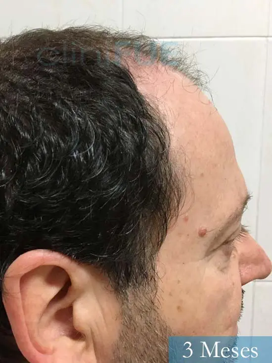 Jordi 56 Tarragona trasplante capilar turquia 3 meses 