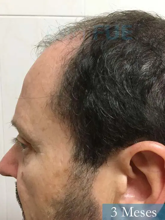 Jordi 56 Tarragona trasplante capilar turquia 3 meses 4