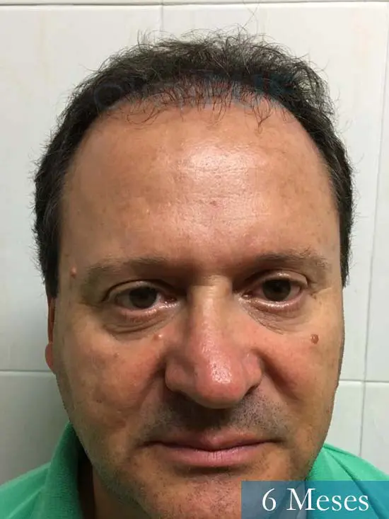 Jordi 56 Tarragona trasplante capilar turquia 6 meses 