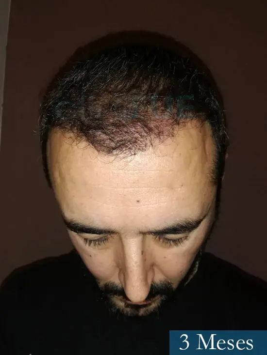 Jordi 41 años injerto capilar turquia segunda operacion 3 meses 2