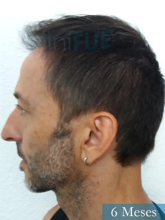 Jose Luis 49 Madrid trasplante capilar turquia 6 meses 4