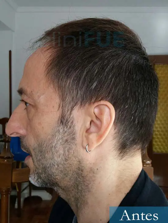 Jose Luis 49 Madrid trasplante capilar turquia antes 5