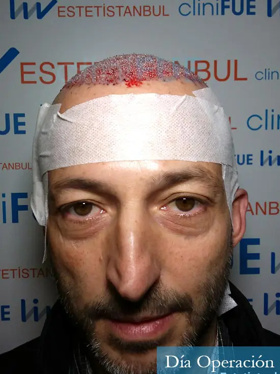 Jose Luis 49 Madrid trasplante capilar turquia dia operacion 