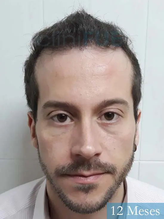 Marc 30 Tarragona trasplante capilar turquia 12 meses 