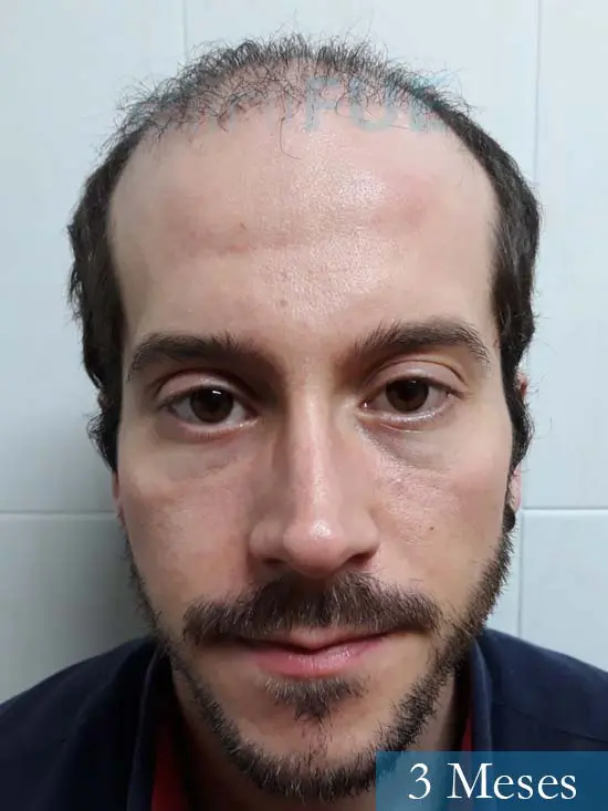 Marc 30 Tarragona trasplante capilar turquia 3 meses 