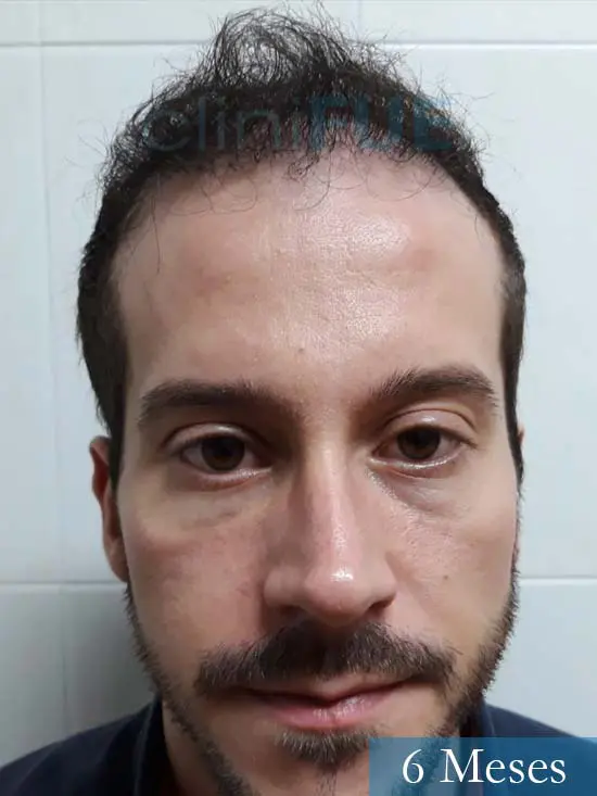 Marc 30 Tarragona trasplante capilar turquia 6 meses 