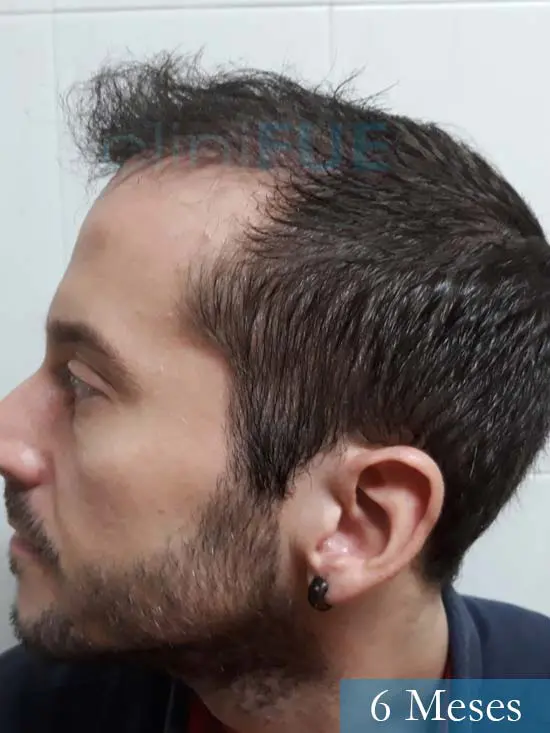 Marc 30 Tarragona trasplante capilar turquia 6 meses 5