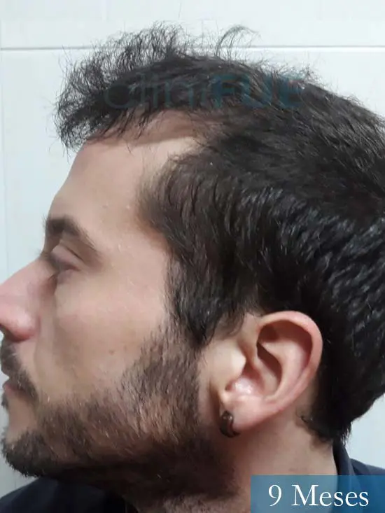 Marc 30 Tarragona trasplante capilar turquia 9 meses 4