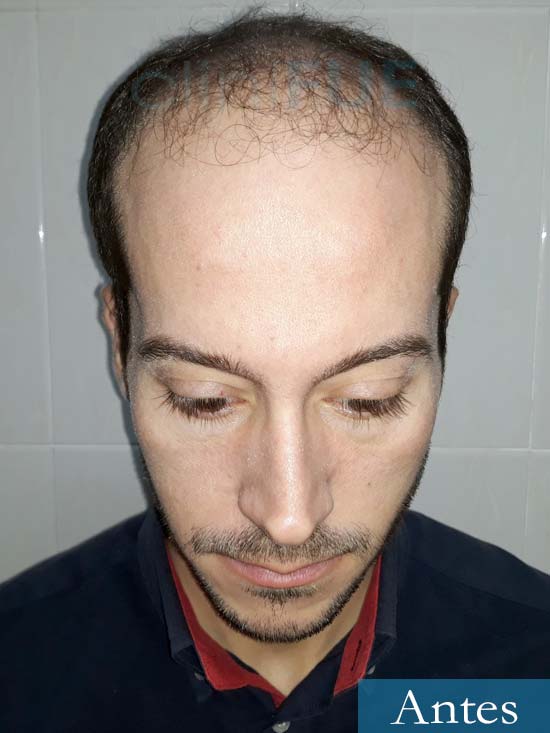 Marc 30 Tarragona trasplante capilar turquia antes 2