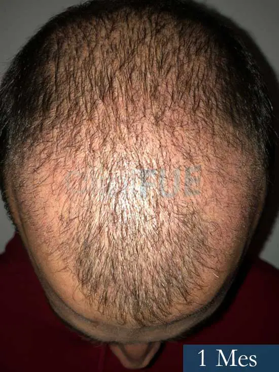 Miguel 31 años Barcelona trasplante capilar turquia 1 mes 2