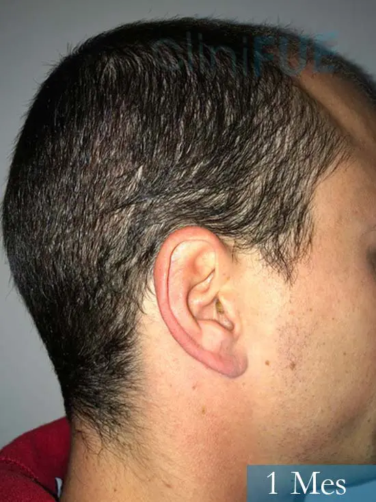 Miguel 31 años Barcelona trasplante capilar turquia 1 mes 3