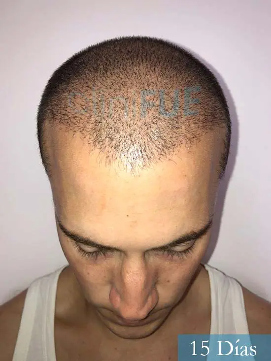 Miguel 31 años Barcelona trasplante capilar turquia 15 dias 2