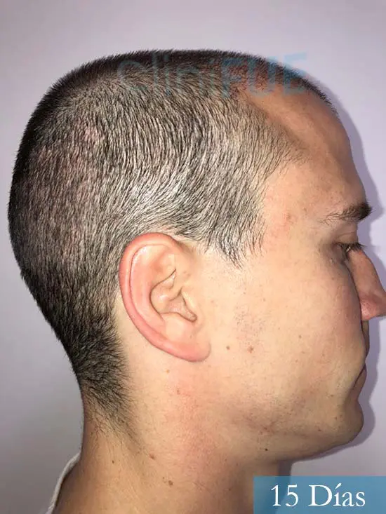 Miguel 31 años Barcelona trasplante capilar turquia 15 dias 3