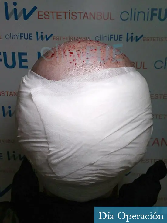 Miguel 31 años Barcelona trasplante capilar turquia dia operacion 5