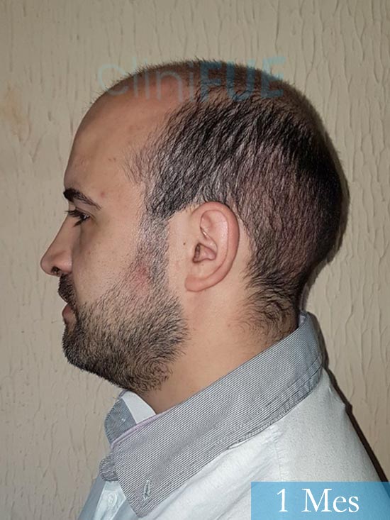 Oscar 34 Zamora trasplante capilar turquia 1 mes 