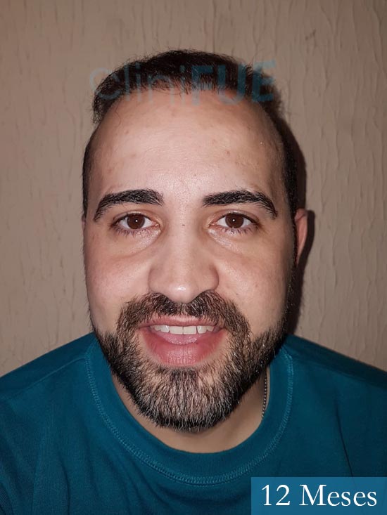 Oscar 34 Zamora trasplante capilar turquia 12 meses 