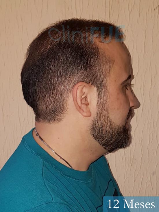 Oscar 34 Zamora trasplante capilar turquia 12 meses 3