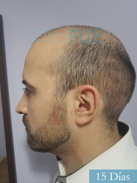 Oscar 34 Zamora trasplante capilar turquia 15 dias 5