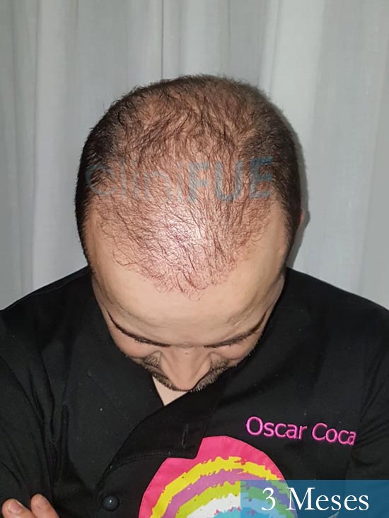 Oscar 34 Zamora trasplante capilar turquia 3 meses 2