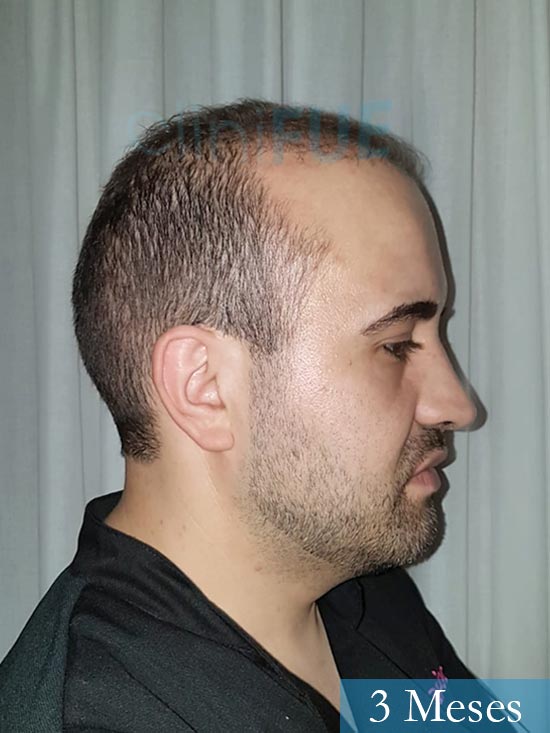 Oscar 34 Zamora trasplante capilar turquia 3 meses 3