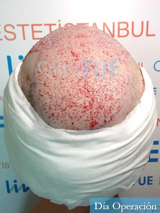 Eusebio 29 Barcelona trasplante pelo dia operacion 6