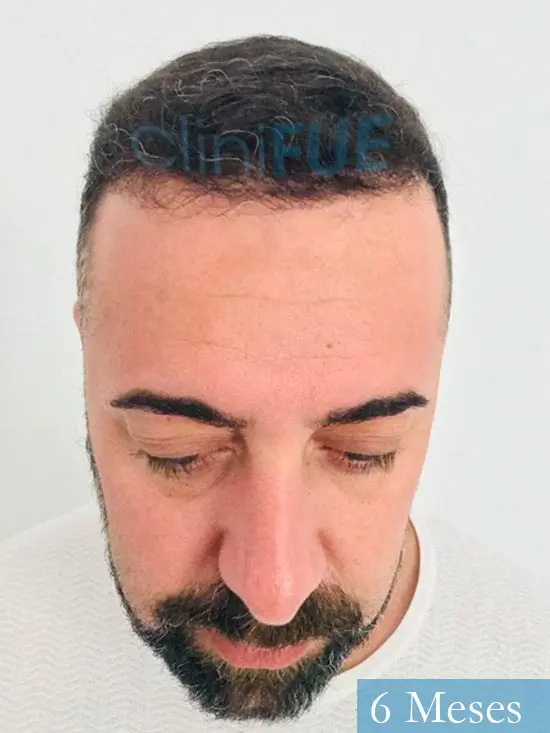 Jose Manuel 36 anos Cadiz injerto pelo turquia 6 meses 