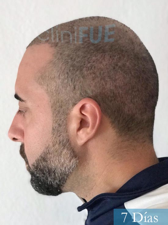Jose-Manuel-36-Cadiz-trasplante-turquia-7 dias 
