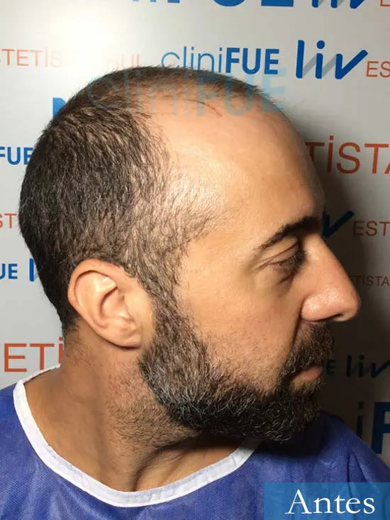 Jose Manuel 34 anos Cadiz injerto pelo turquia dia operacion antes 3