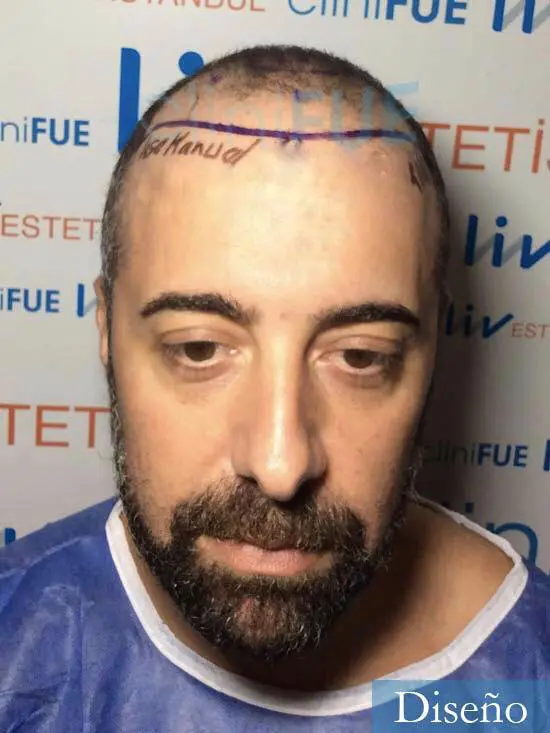 Jose-Manuel-36-Cadiz-trasplante-turquia-dia-operacion-diseno-1