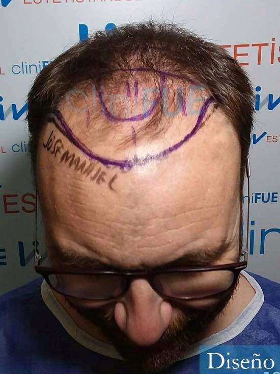 Jose-manuel-trasplante-de-pelo-turquia-dia-operacion-diseno-2