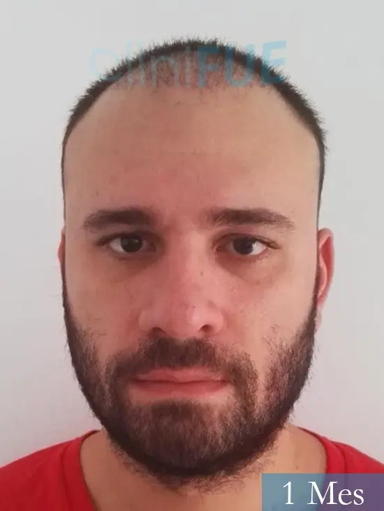Miquel 32 años de barcelona injerto capilar turquia 1 mes 