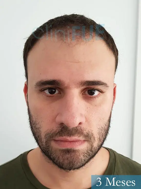 Miquel 32 años de barcelona injerto capilar turquia 3 meses 