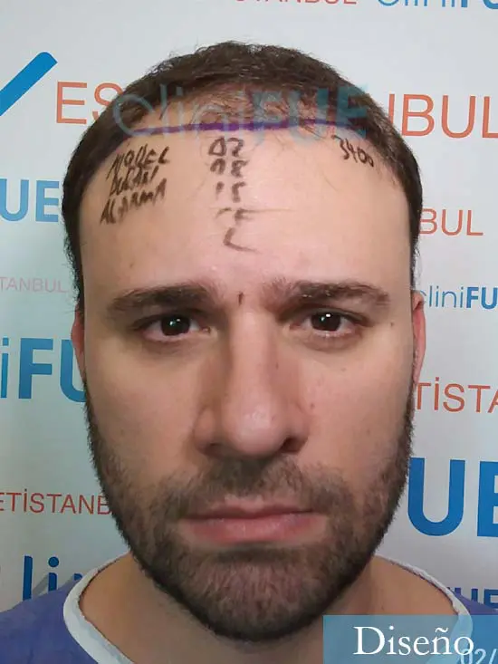 Miquel 32 años de barcelona injerto capilar turquia dia operacion diseno 