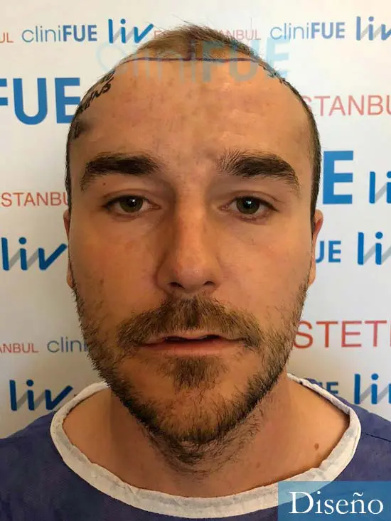Pedro 32 anos Barcelona injerto de pelo dia operacion diseno 1