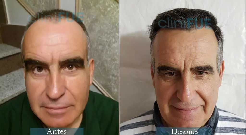Injerto capilar de Carlos 59 Años de Madrid con cliniFUE