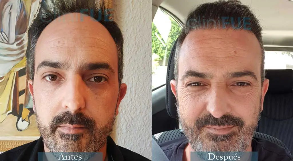 trasplante-capilar-daniel-41-anos-barcelona-clinifue