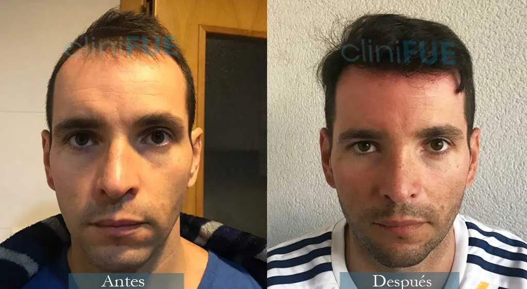 Trasplante capilar de José Iñaki 34 Años de Alicante con cliniFUE