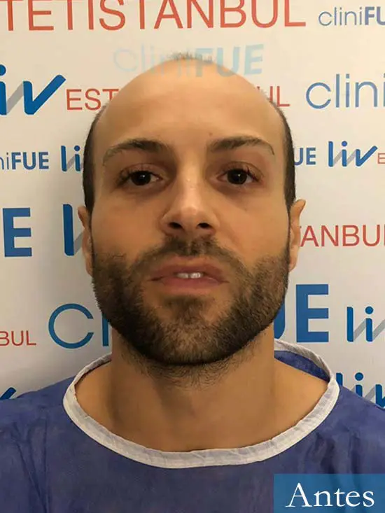 Alberto 27 Valencia trasplante capilar cliniFUE dia operacion 