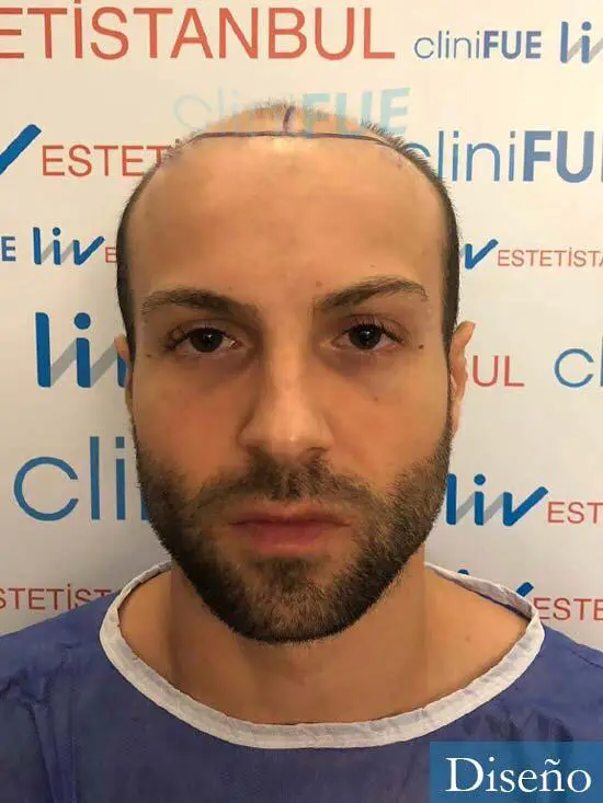 Alberto 27 Valencia trasplante capilar cliniFUE dia operacion diseno 
