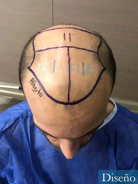 Alberto 27 Valencia trasplante capilar cliniFUE dia operacion diseno 2