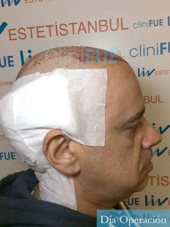 Emiliano 57 Las palmas injerto de pelo dia operacion 3