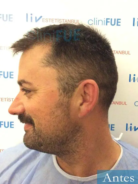 Carlos 38 anos trasplante turquia antes 4