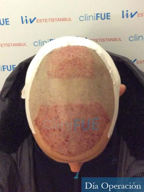 Carlos 38 anos trasplante turquia dia operacion 2