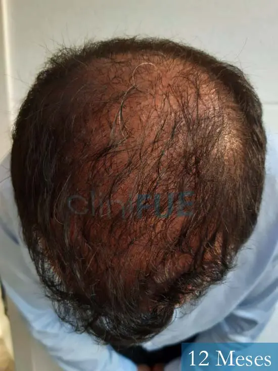 Javier-38-Guadalajara-trasplante-capilar-turquia 12 meses 2