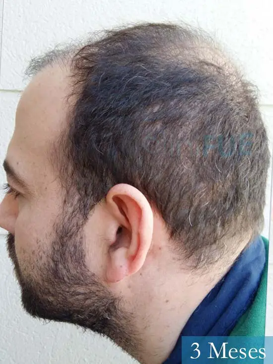 Javier-38-Guadalajara-trasplante-capilar-turquia 3 meses 4