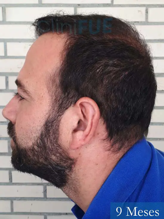 Javier-38-Guadalajara-trasplante-capilar-turquia 9 meses 5