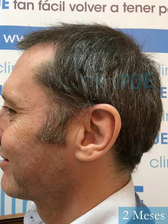 Cristobal 46 Bilbao injerto capilar turquia 2 meses desde trasplante de pelo 