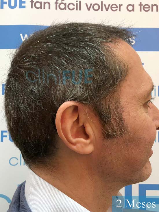 Cristobal 46 Bilbao injerto capilar turquia 2 meses desde trasplante de pelo 