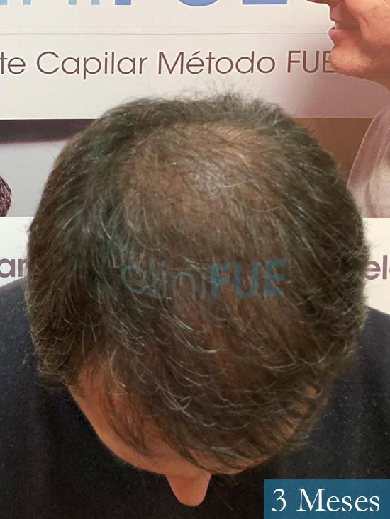 Cristobal 46 Bilbao injerto capilar turquia 3 meses desde trasplante de pelo 